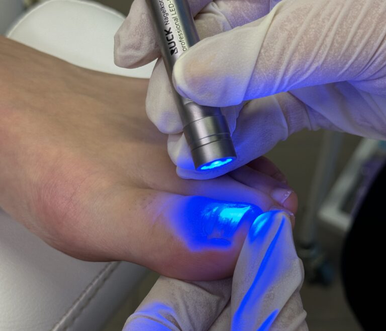 Blue Light tretman za urasle nokte